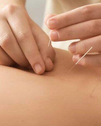 dry needling